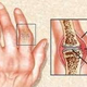 Illustration for article titled Obat Yang Manjur Untuk Penyakit Asam Uratem/em